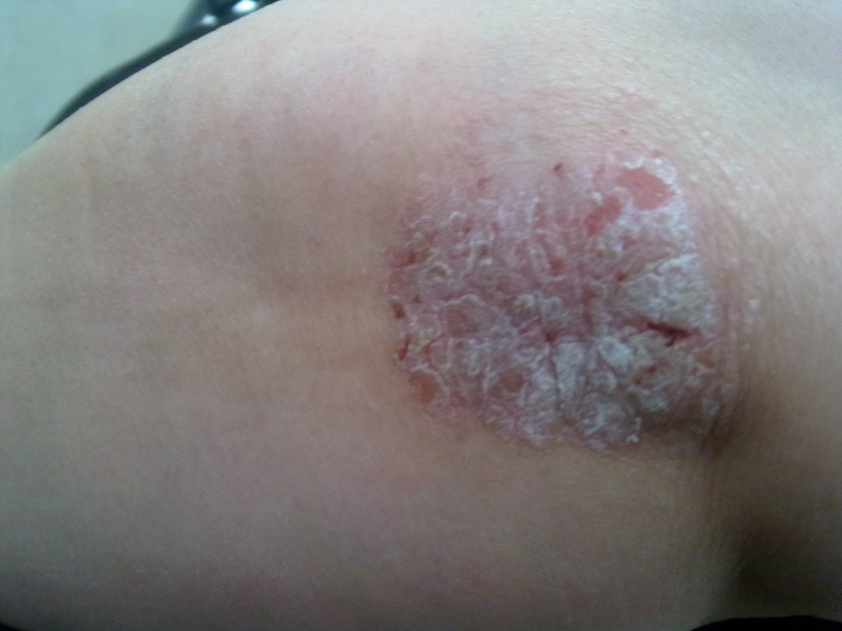 Psoriasis en placas en el codo — escama seca, gruesa y plateada