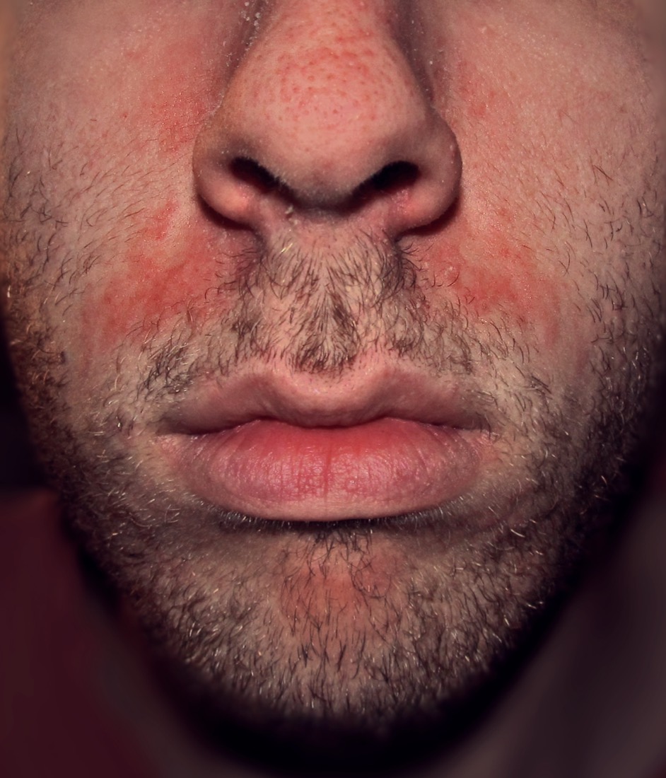 Dermatitis seborreica en la cara — enrojecimiento y descamación junto a la nariz